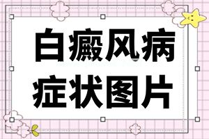 小孩脸上白斑多长时间能治好,白癜风都有什么症状(不同时期的病发表现是怎样的)