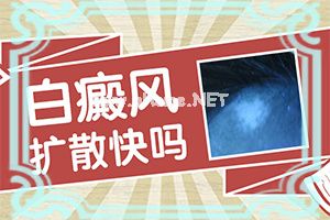 儿童发现白殿风能治好吗[治白斑怎么治好得快]白班怎么治疗方法